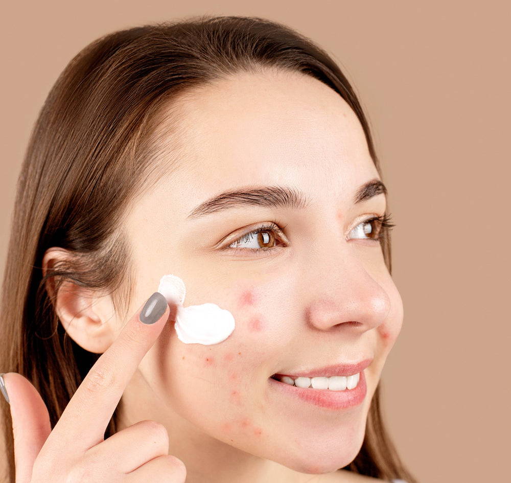Hautproblem Akne behandeln mit Pflegeprodukten